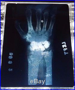 Harry Houdini 8 X 10 X-ray Of His Hand With A Bullet Lodged In It With Coa